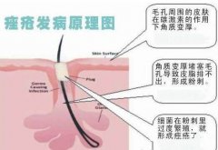 痤瘡治療的誤區(qū)有什么？痤瘡的治療要警惕哪些